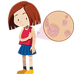 eczema