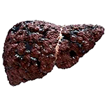 cirrhosis